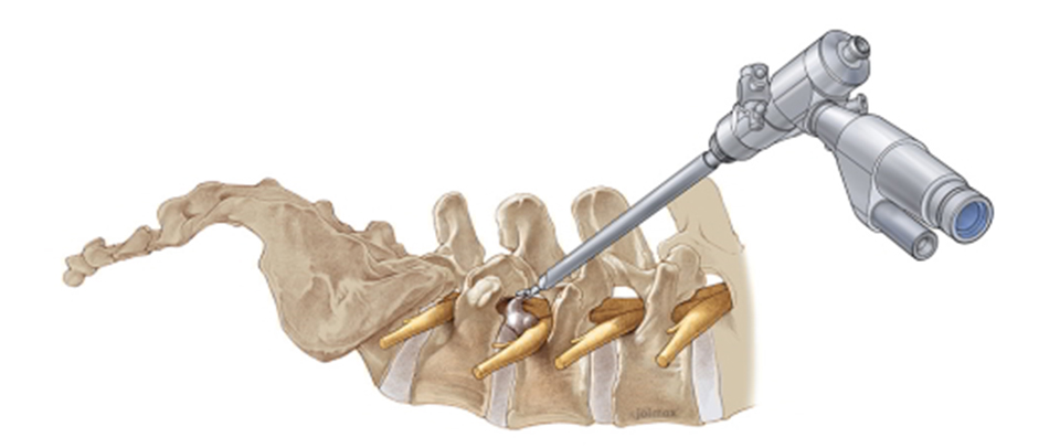 Endoscopic Spine Treatment in Kandivali, Mumbai