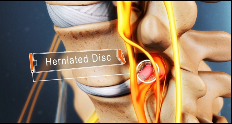 Slipped Disc/Prolapsed Disc Treatment in Kandivali
