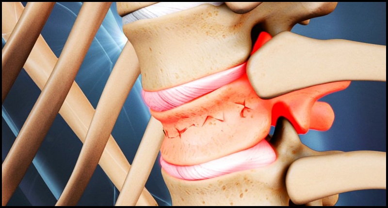 Spinal Factures Treatment in Kandivali