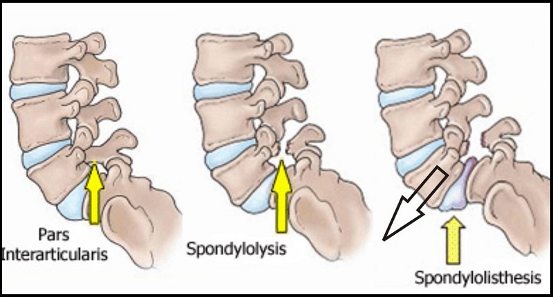 Spondylolisthesis Treatment in Kandivali