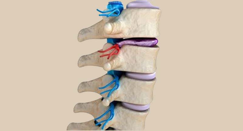 Best Degenerative Spinal Disorder Treatment in Kandivali, Mumbai