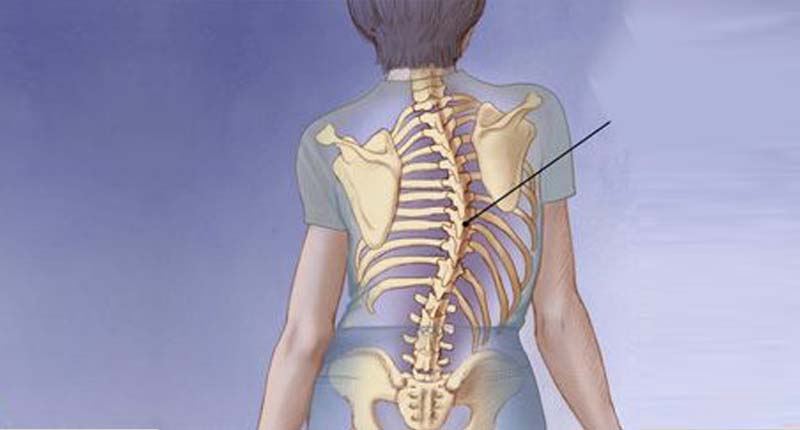 Spinal Deformity Correction treatment in Kandivali, Mumbai