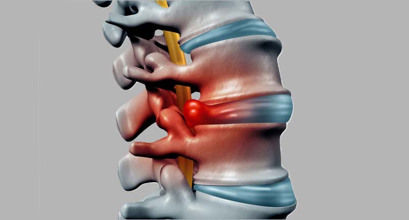 Spinal Infection Treatment in Kandivali