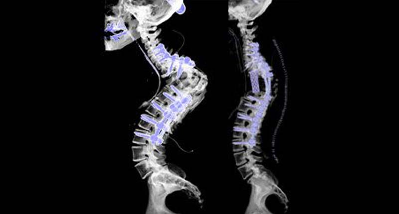 Spinal Reconstruction Surgery Treatment in Kandivali